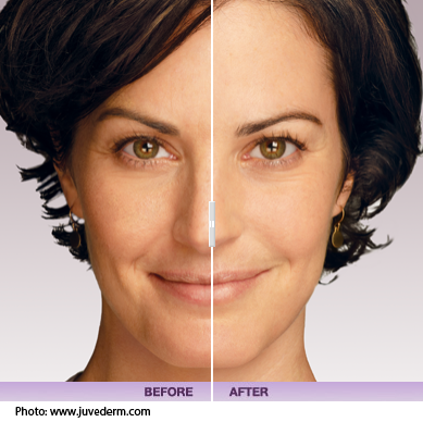 juvederm before after photo
